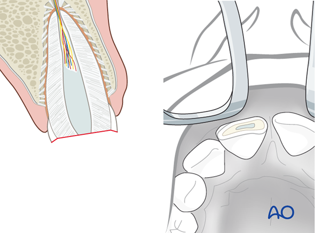 Pulp extirpation