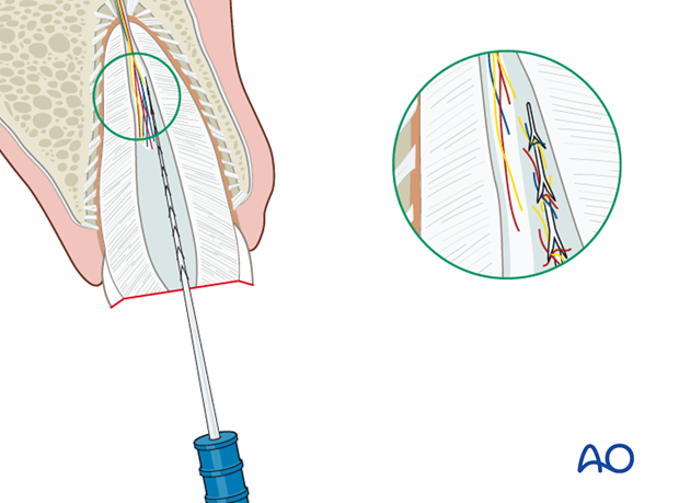 Removal of necrotic pulp