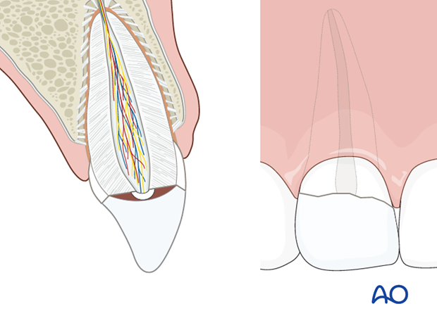 Reattached crown segment