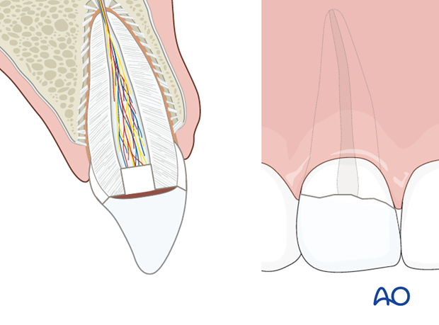 Reattached crown segment