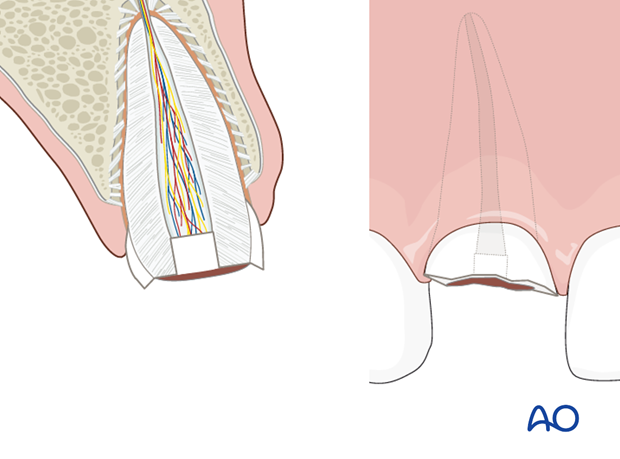 Placed calcium hydroxide seal in the root canal