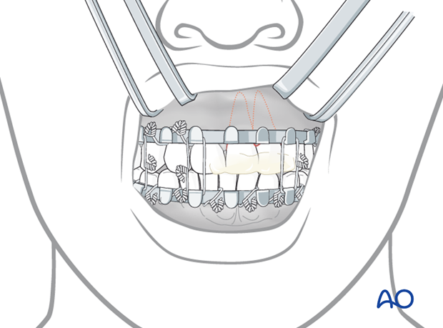 introduction to dentoalveolar trauma