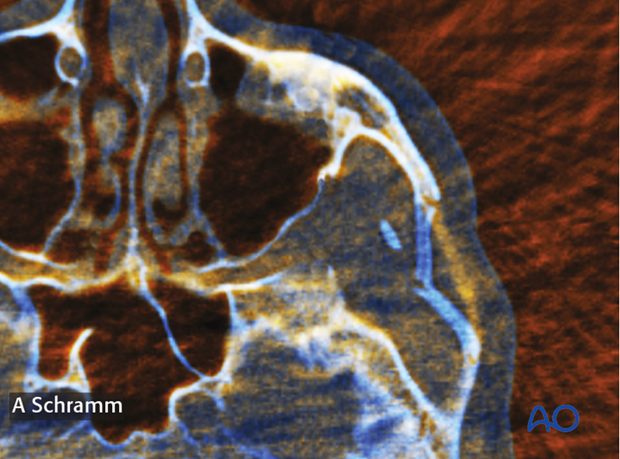 computer assisted surgery zygomatic arch intraoperative imaging closed reduction