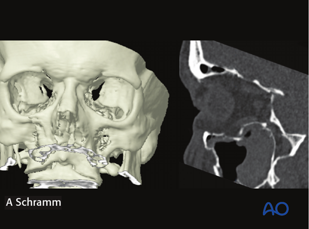 cas virtual planning and intraoperative imaging orif without orbital reconstruction