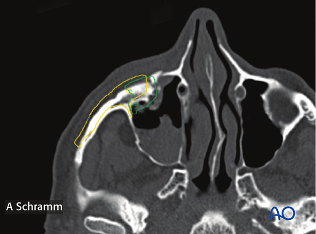 cas virtual planning and intraoperative imaging orif without orbital reconstruction