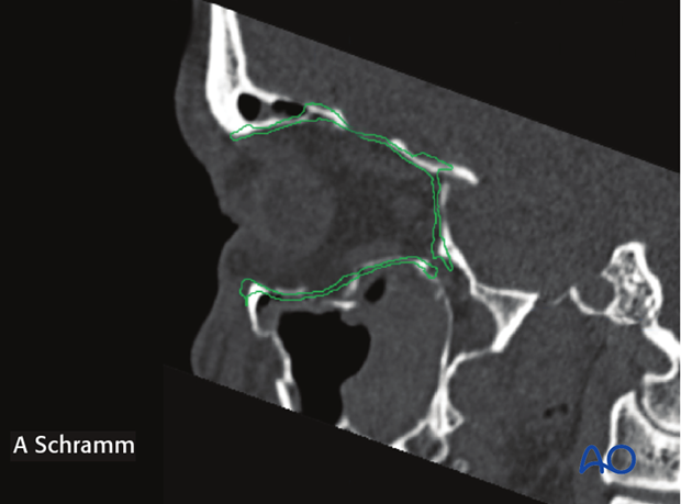 cas virtual planning and intraoperative imaging orif without orbital reconstruction