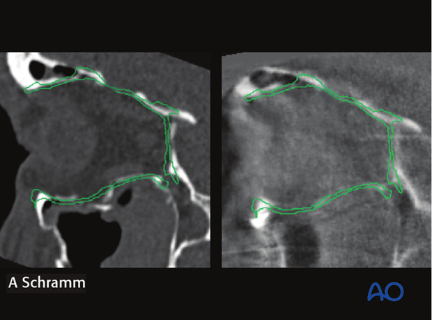 cas virtual planning and intraoperative imaging orif without orbital reconstruction