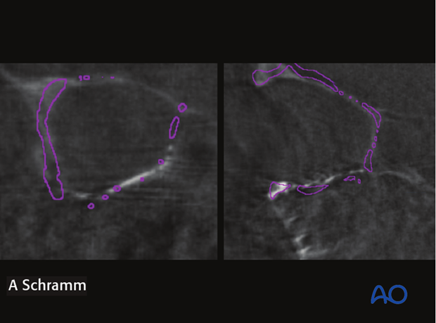 cas virtual planning and intraoperative imaging orif with orbital reconstruction