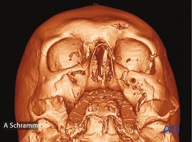 zygomatic complex fracture