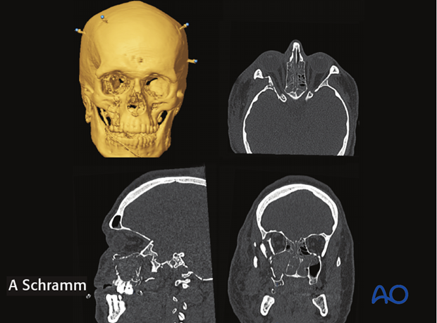 cas virtual planning and intraoperative navigation orif with orbital reconstruction