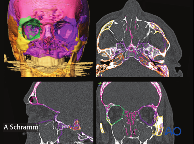 cas virtual planning and intraoperative navigation orif with orbital reconstruction