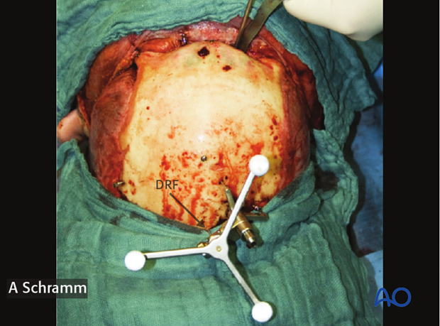 computer assisted surgery gunshot injury virtual planning and intraoperative navigation