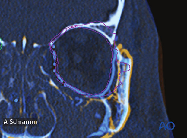 cas virtual planning and intraoperative navigation orif with orbital reconstruction