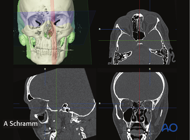 computer assisted surgery orbit virtual planning and intraoperative navigation