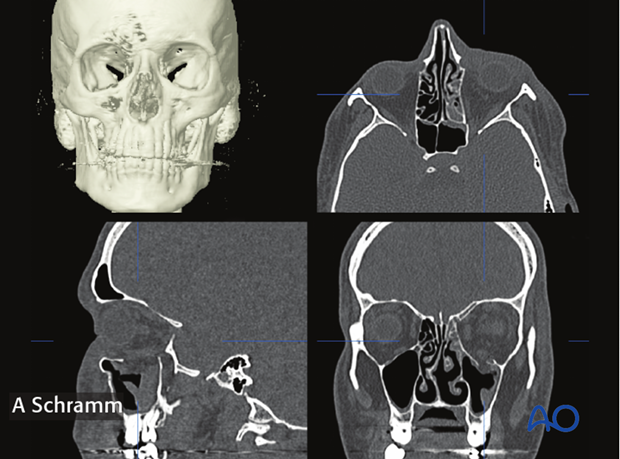 computer assisted surgery orbit virtual planning and intraoperative navigation