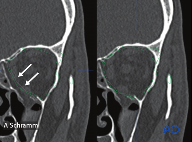 computer assisted surgery orbit virtual planning and intraoperative navigation