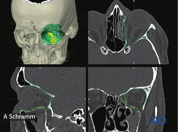 computer assisted surgery orbit virtual planning and intraoperative navigation