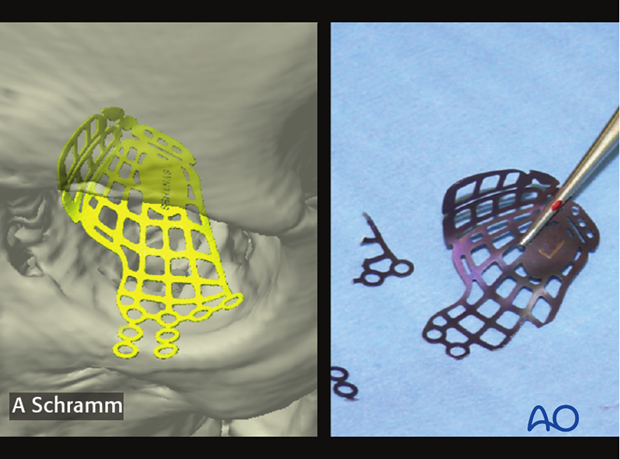 computer assisted surgery orbit virtual planning and intraoperative navigation