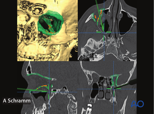 CAS computer assisted surgery