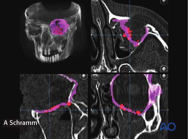 computer assisted surgery orbit virtual planning and intraoperative navigation