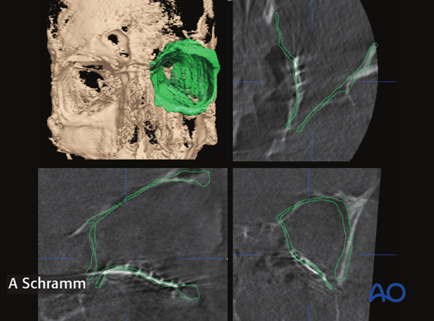 computer assisted surgery orbit virtual planning and intraoperative navigation