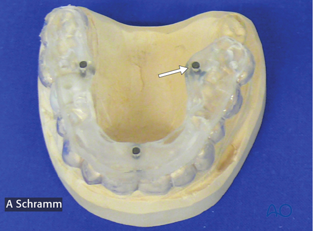 computer assisted dental implant surgery