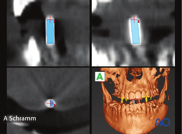 computer assisted dental implant surgery