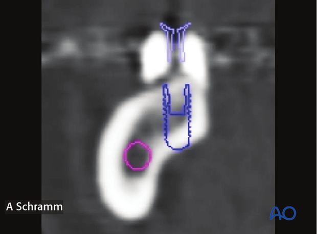 computer assisted dental implant surgery