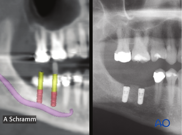 computer assisted dental implant surgery