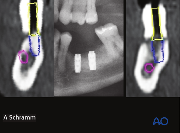 computer assisted dental implant surgery