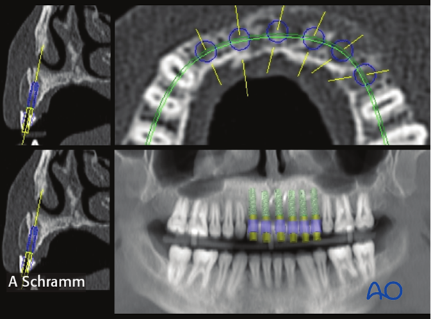 computer assisted dental implant surgery