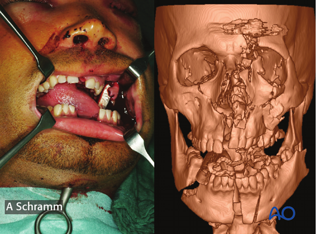 computer assisted surgery gunshot virtual planning and intraoperative navigation gunshot