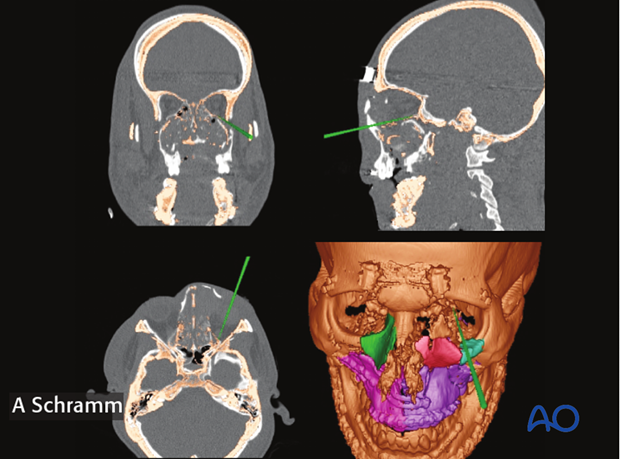 computer assisted surgery gunshot virtual planning and intraoperative navigation gunshot