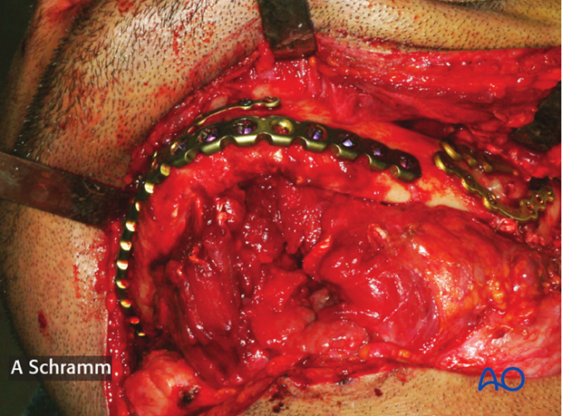 computer assisted surgery gunshot virtual planning and intraoperative navigation gunshot