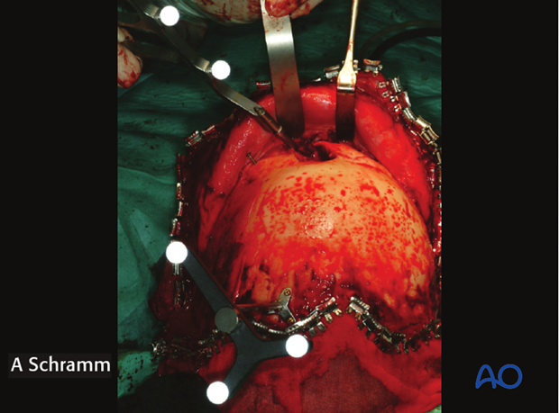 computer assisted surgery gunshot virtual planning and intraoperative navigation gunshot