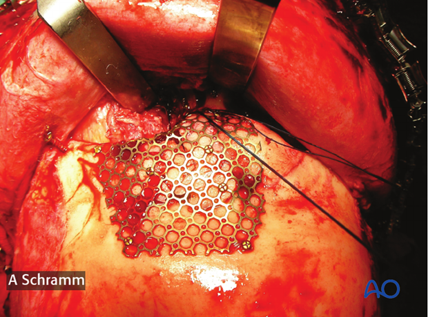 computer assisted surgery gunshot virtual planning and intraoperative navigation gunshot