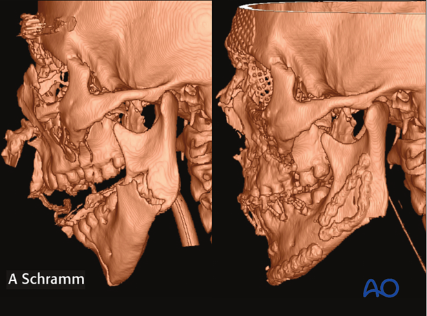 computer assisted surgery gunshot virtual planning and intraoperative navigation gunshot