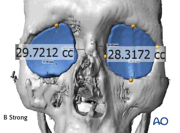 CAS computer assisted surgery