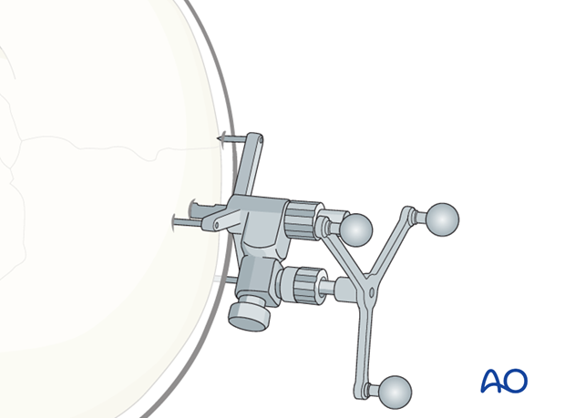 CAS preparation for intraoperative navigation