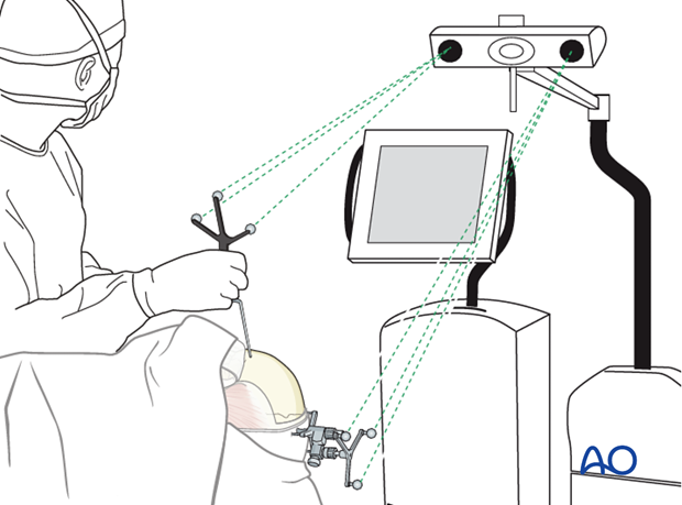 CAS preparation for intraoperative navigation