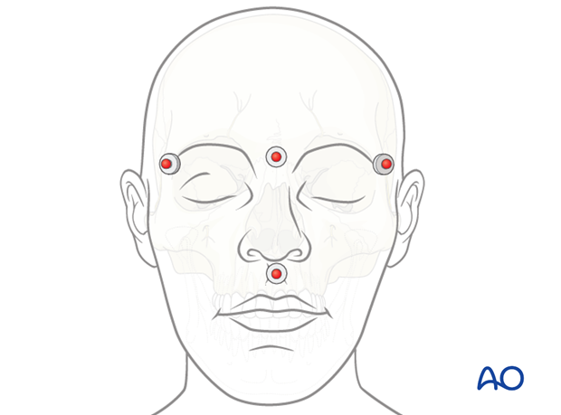 CAS preparation for intraoperative navigation