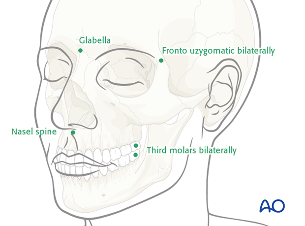 CAS preparation for intraoperative navigation