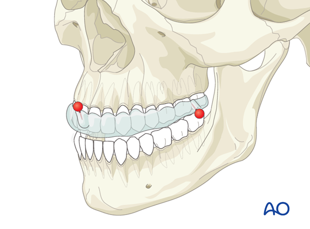 CAS preparation for intraoperative navigation