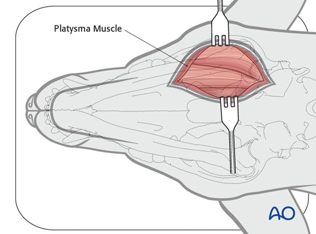 Ventral approach to caudal mandible anatomical exposure platysma muscle|alt