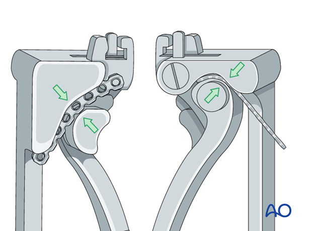 The mandibular reconstruction plate is anatomically contoured using bending pliers