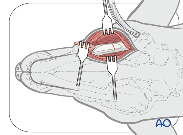 plate fixation