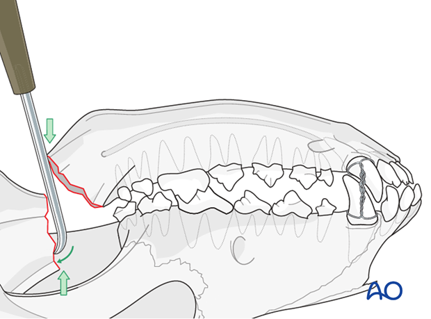 plate fixation