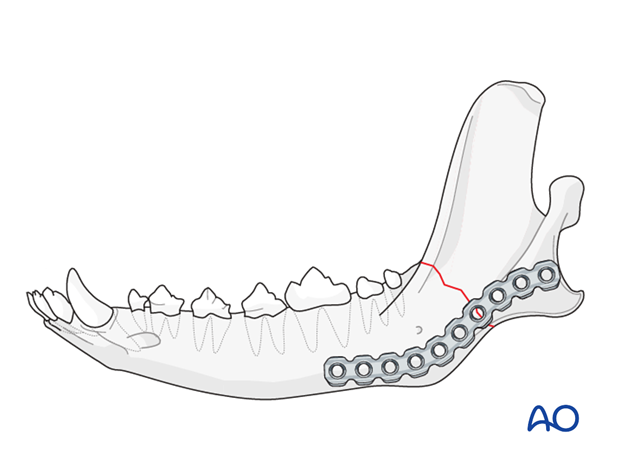 plate fixation