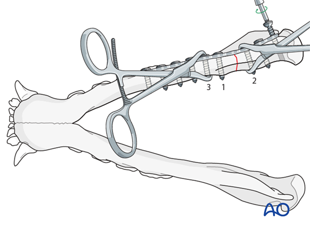 plate fixation