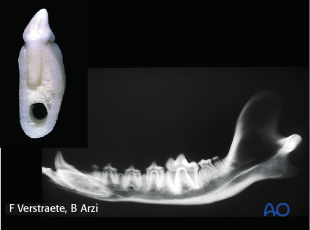 general considerations with mandible fractures